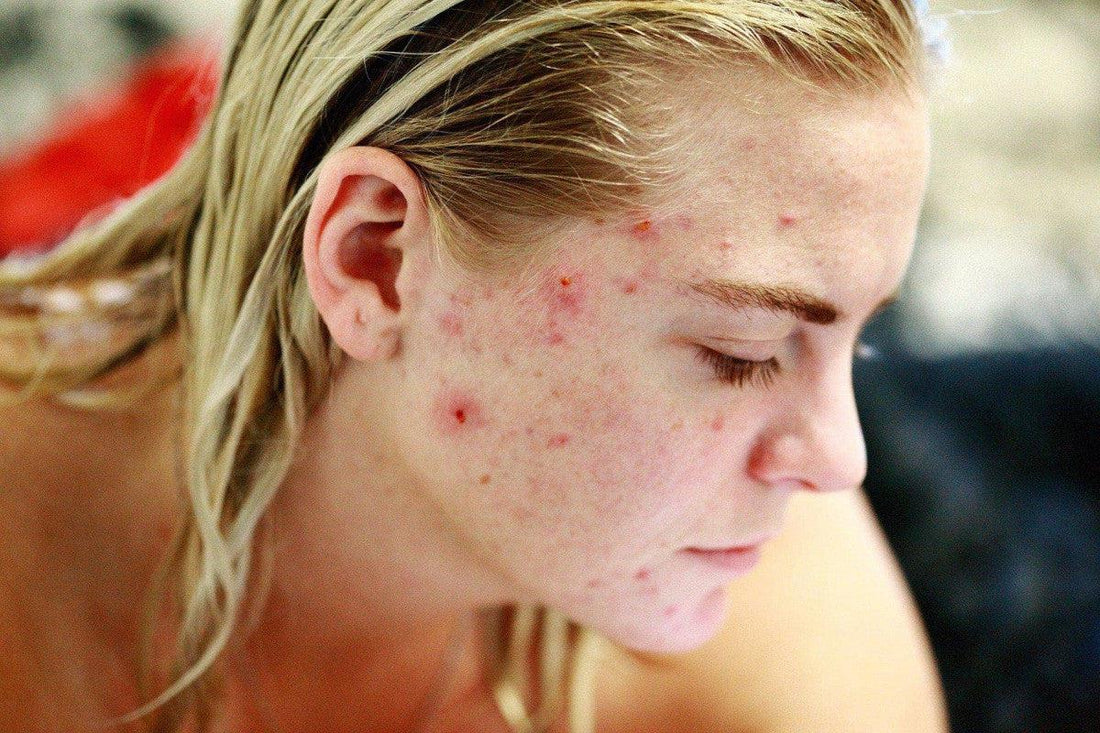 Comment cacher son acné ?