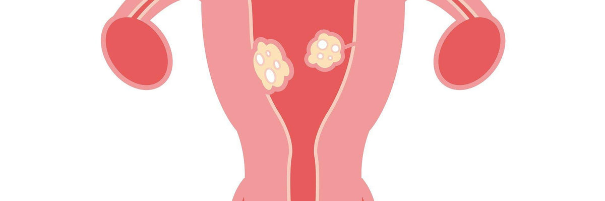 Qu'est-ce que le fibrome utérin ?