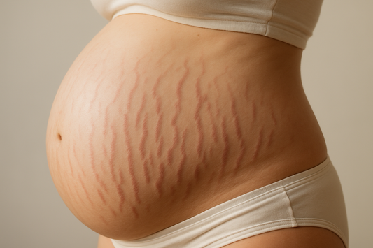 Vergetures de grossesse : prévention, traitements et conseils